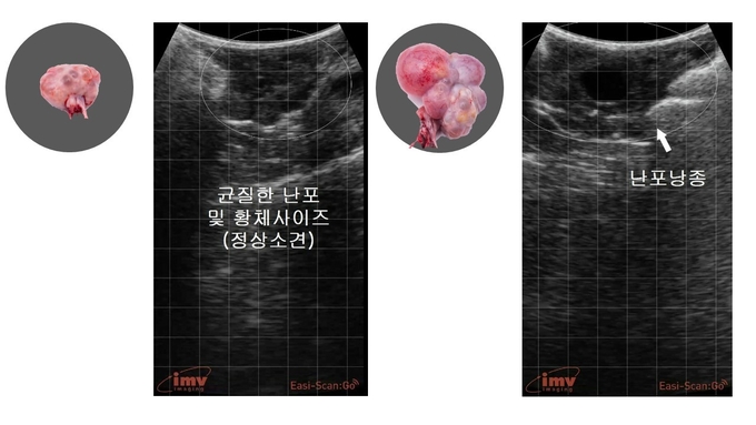 직장초음파를 활용한 난소의 상태파악